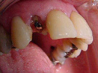 Fractured upper lateral incisor tooth